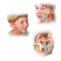 MOJO-TMJ-Gesundheitsschiene für Kinder
